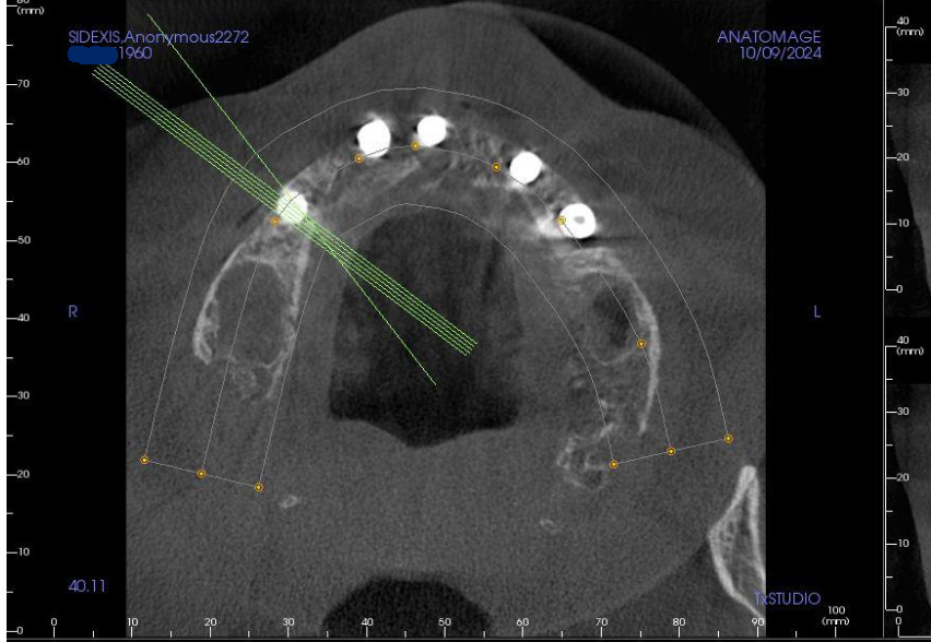Incorrect positioning of implants shown on radiology report