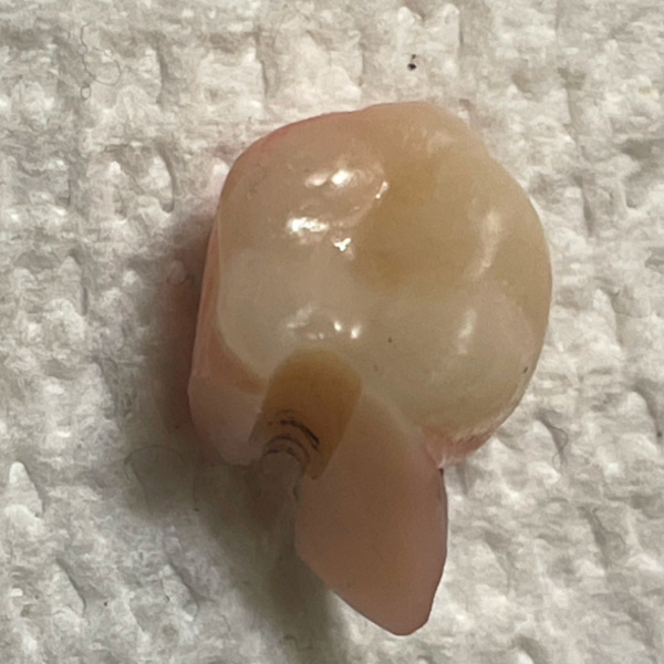 Molar that broke off at screw hole