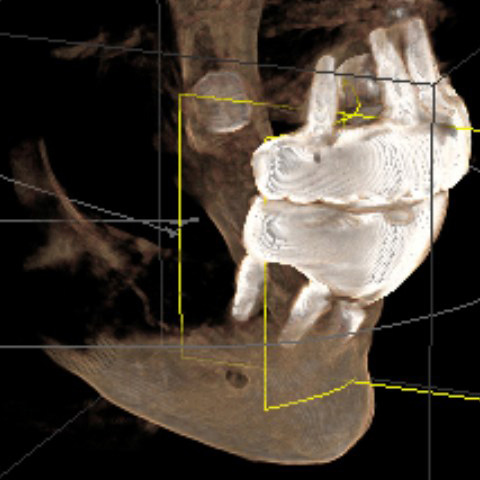 3D Sirona model slice from Oct 2024 CBCT showing no bone support under rear implant, botched dental implant placed by Dr Shobhit Bansal at his Dental Arts of Huntley