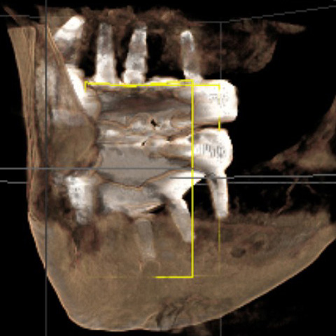 3D slice from Oct 9, 2024 CBCT showing no bone support under rear implant. Botched dental implant placed by Dr Shobhit Bansal at his Dental Arts of Huntley.