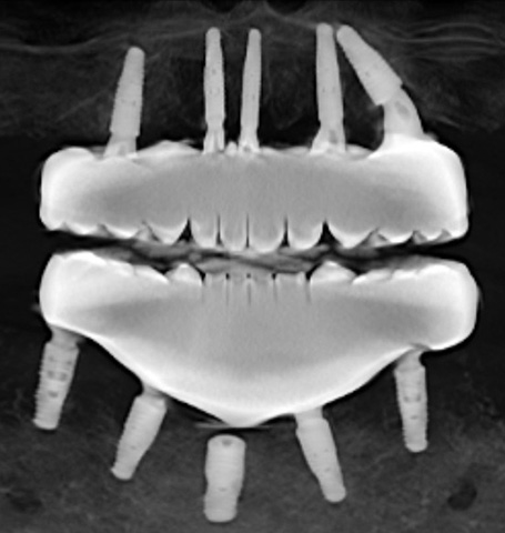 Panoramic view of Dr Shobhit Bansal's failed dental implants including one unused mystery implant, image from Oct 2024 CBCT